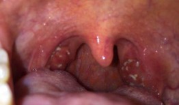 吃瓜喉咙感觉痛,揭秘喉咙不适背后的真相